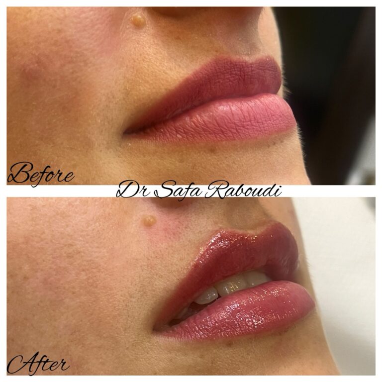 lip filler cosmo sercrets