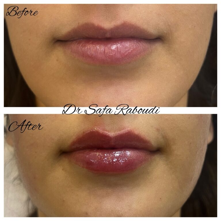 lip filler for women cosmo secrets