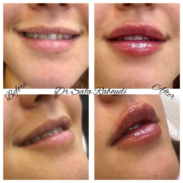 lip filler for women cosmo secrets