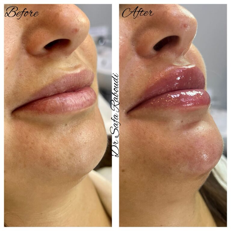 lip filler for women cosmo secrets