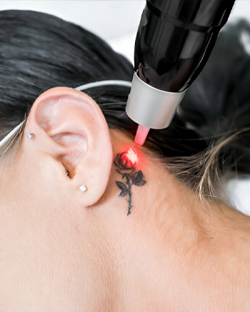 A women doing tattoo removal at Cosmo Secrets