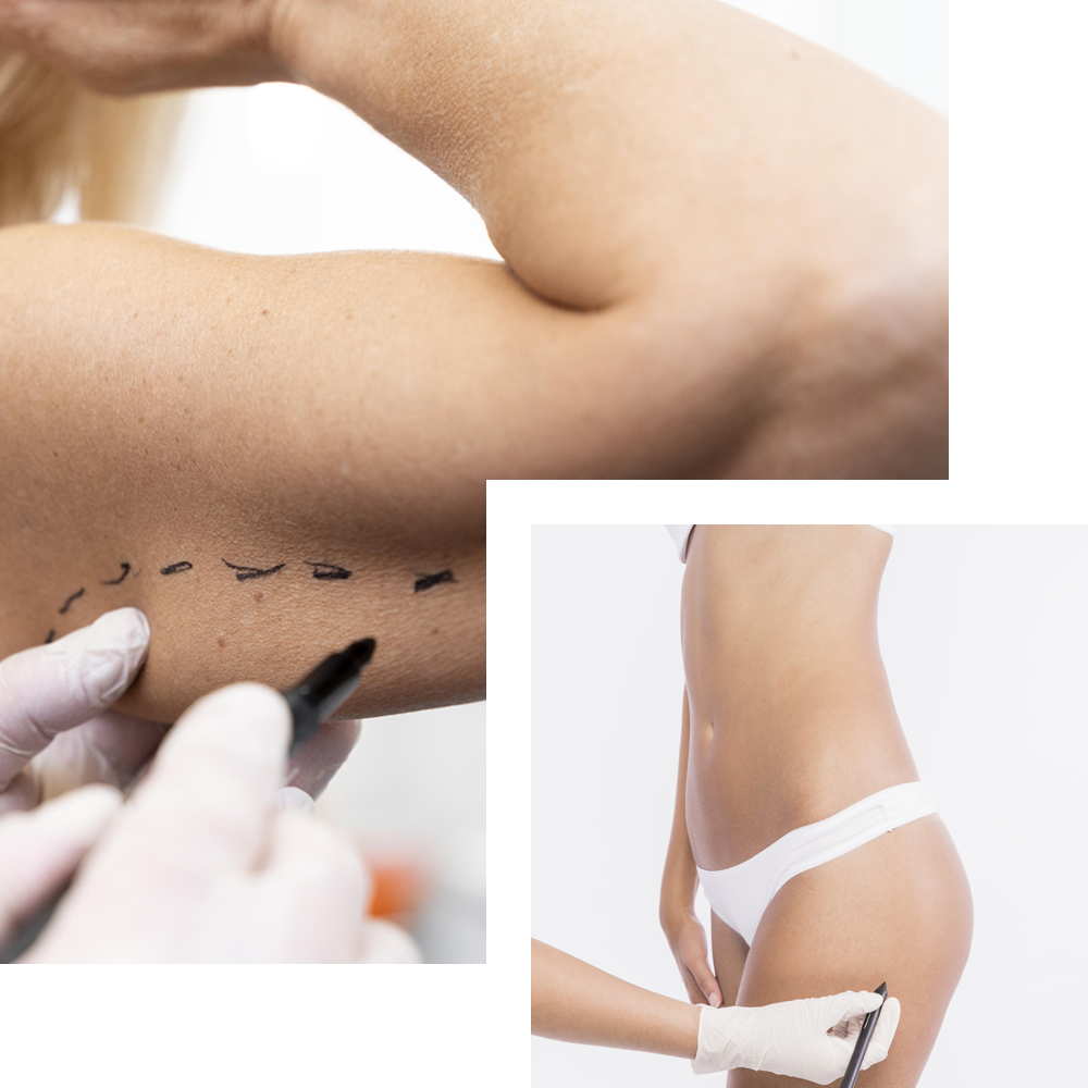 Cosmo Secrets Medical Centre team performing body filler injections, focusing on creating natural-looking enhancements.