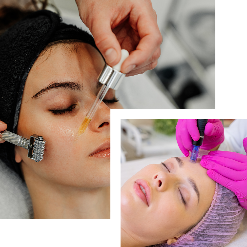 Microneedling treatment at Cosmo Secrets Medical Centre, utilizing fine needles to create micro-injuries that stimulate collagen production for smoother, revitalized skin.