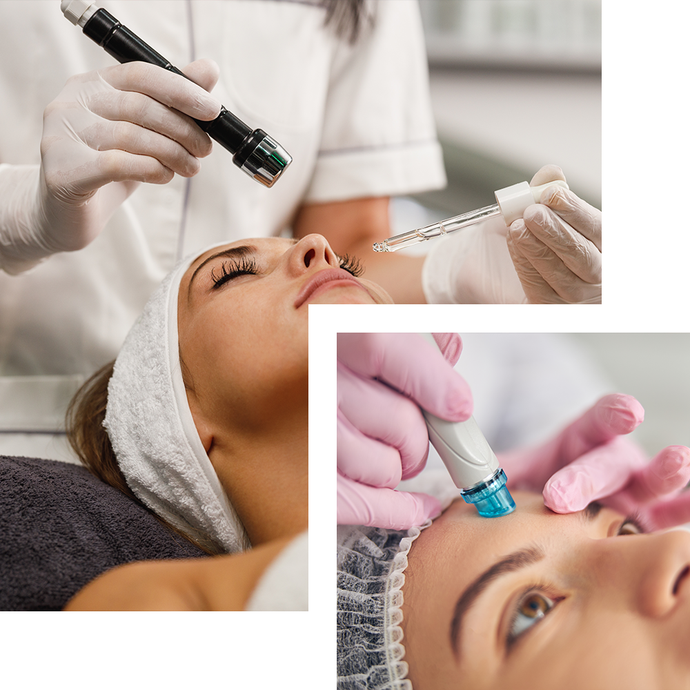 Microneedling treatment at Cosmo Secrets Medical Centre, utilizing fine needles to create micro-injuries that stimulate collagen production for smoother, revitalized skin.