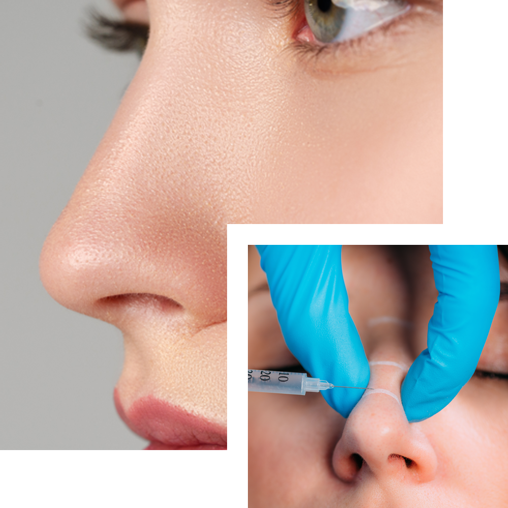 nose filler