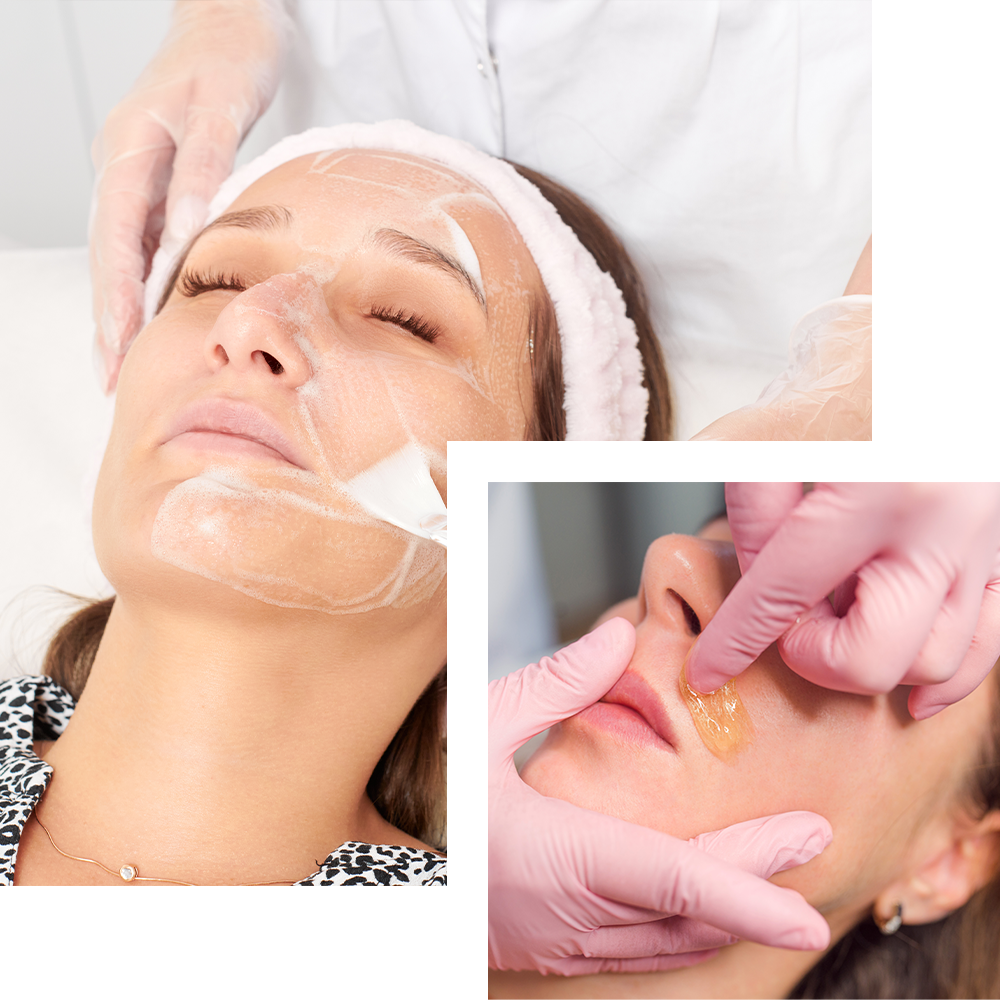 Chemical peeling treatment at Cosmo Secrets Medical Centre, exfoliating the skin to improve texture, tone, and reduce the appearance of fine lines.