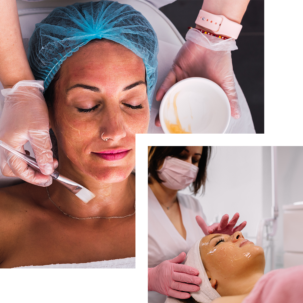 Chemical peeling treatment at Cosmo Secrets Medical Centre, exfoliating the skin to improve texture, tone, and reduce the appearance of fine lines.