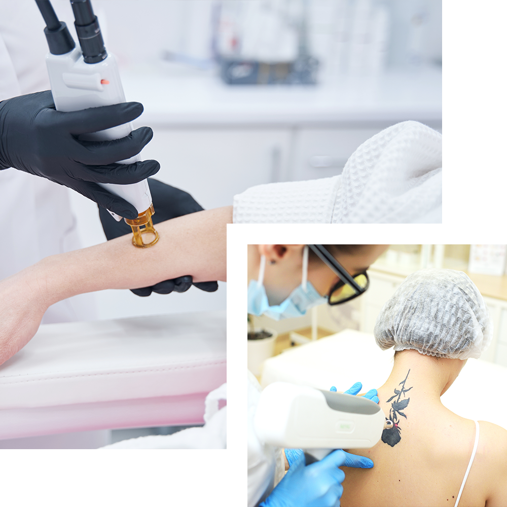 Tattoo removal treatment at Cosmo Secrets Medical Centre, using advanced laser technology to safely and effectively eliminate unwanted tattoos while minimizing skin damage.